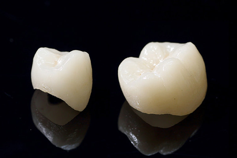 今すでに入れている銀歯を白い歯に変えられますか?