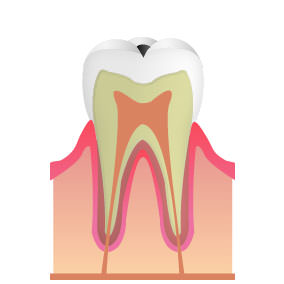 「C1」虫歯がエナメル質まで進んだ段階