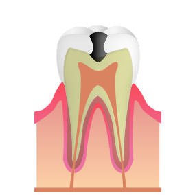 「C2」虫歯が象牙質まで進んだ段階