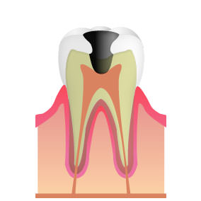 「C3」虫歯が歯髄まで進んだ段階