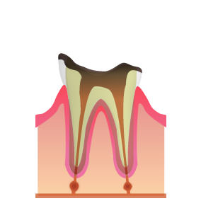 「C4」虫歯が歯根まで進んだ段階