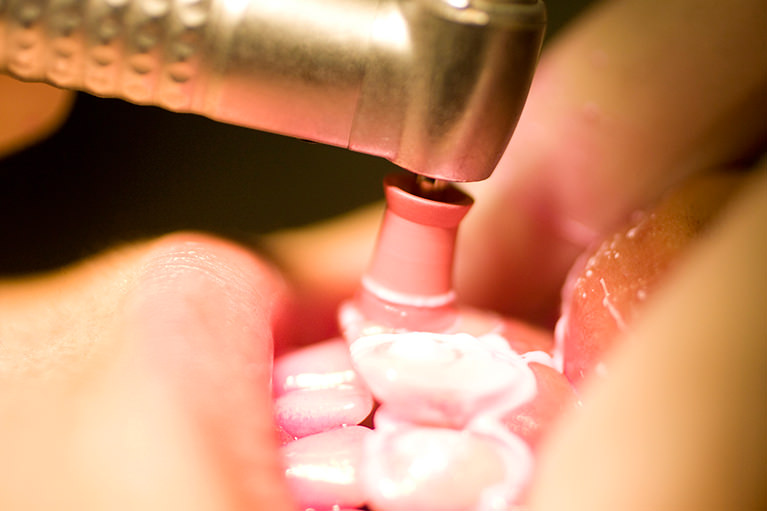 歯のクリーニング（PMTC）をお考えの方へ