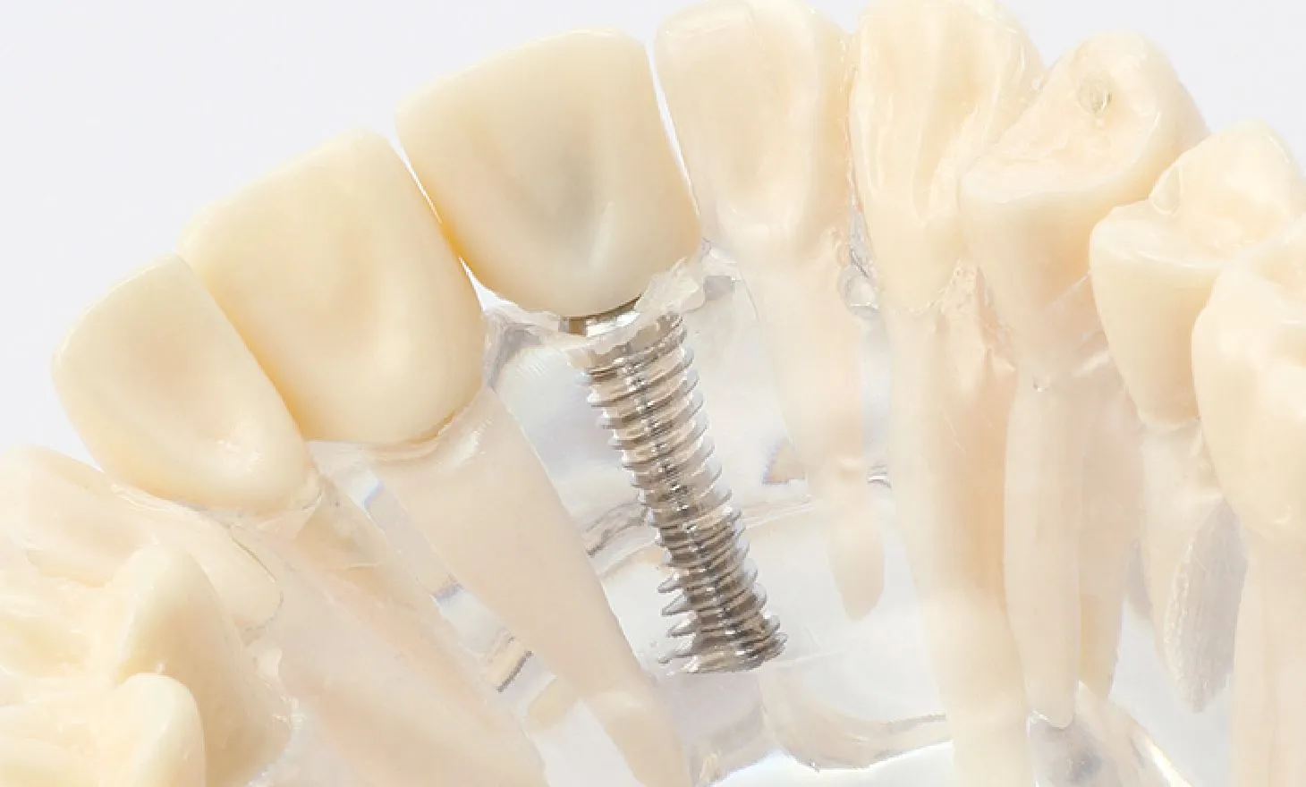 インプラント保証